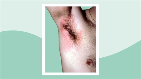 underarm rashes sa kilikili|Armpit Rash: 14 Possible Causes and How to Treat .